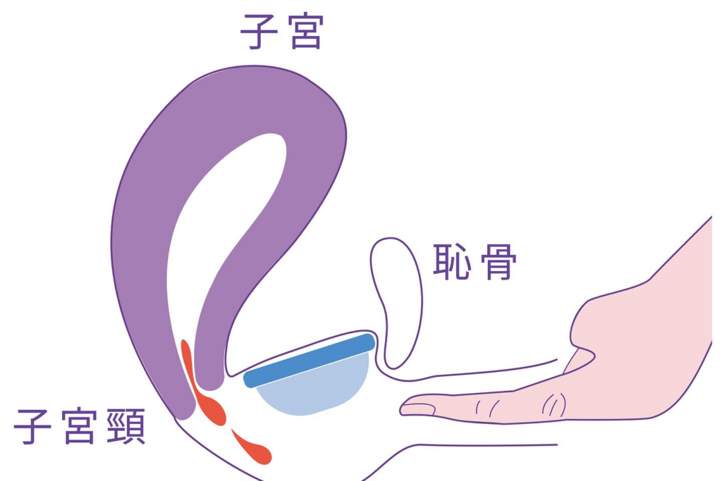 很多人問我們，明明有放進去，也有正確的卡上恥骨，但是為什麼接不到經血？